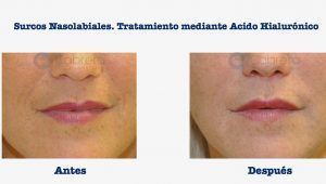 ACIDO-HIALURONICO.001-300x170 Las caras ya no se estiran: ácido hialurónico