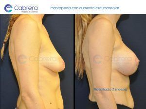 Mastopexia con o sin prótesis | Cómo saber cuál necesitas | Dr. Emilio Cabrera Mastopexia6-300x225 Mastopexia con o sin prótesis | Cómo saber cuál necesitas | Dr. Emilio Cabrera