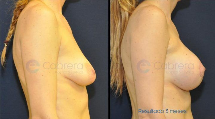 Mastopexia6-720x400 Noticias aumento de pecho