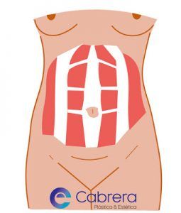 ¿Qué le pasa a mi abdomen? Parece que sigo embarazada un año después de dar a luz abdominoplastia10-255x300 ¿Qué le pasa a mi abdomen? Parece que sigo embarazada un año después de dar a luz