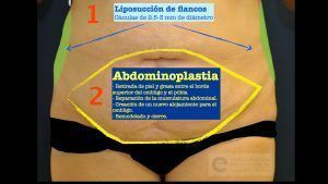 abdominoplastia20-300x169 ¿Puede realizarse en la misma cirugía una abdominoplastia y una liposucción de cintura de forma segura?