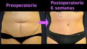 Recuperación de la abdominoplastia | Qué esperar semana a semana | Dr. Emilio Cabrera abdominoplastia21-300x169 Recuperación de la abdominoplastia | Qué esperar semana a semana | Dr. Emilio Cabrera