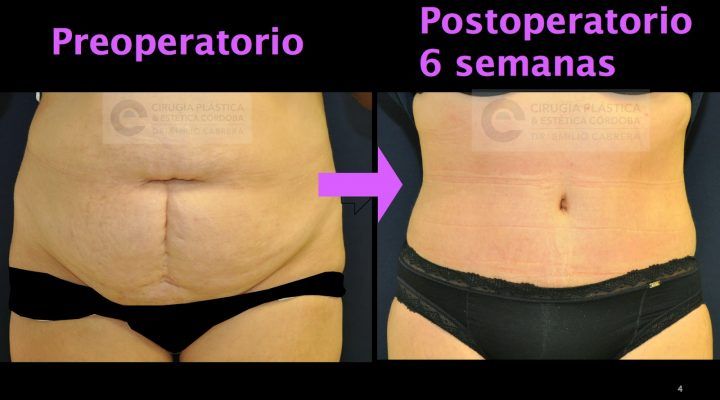 abdominoplastia21-720x400 Noticias abdominoplastia