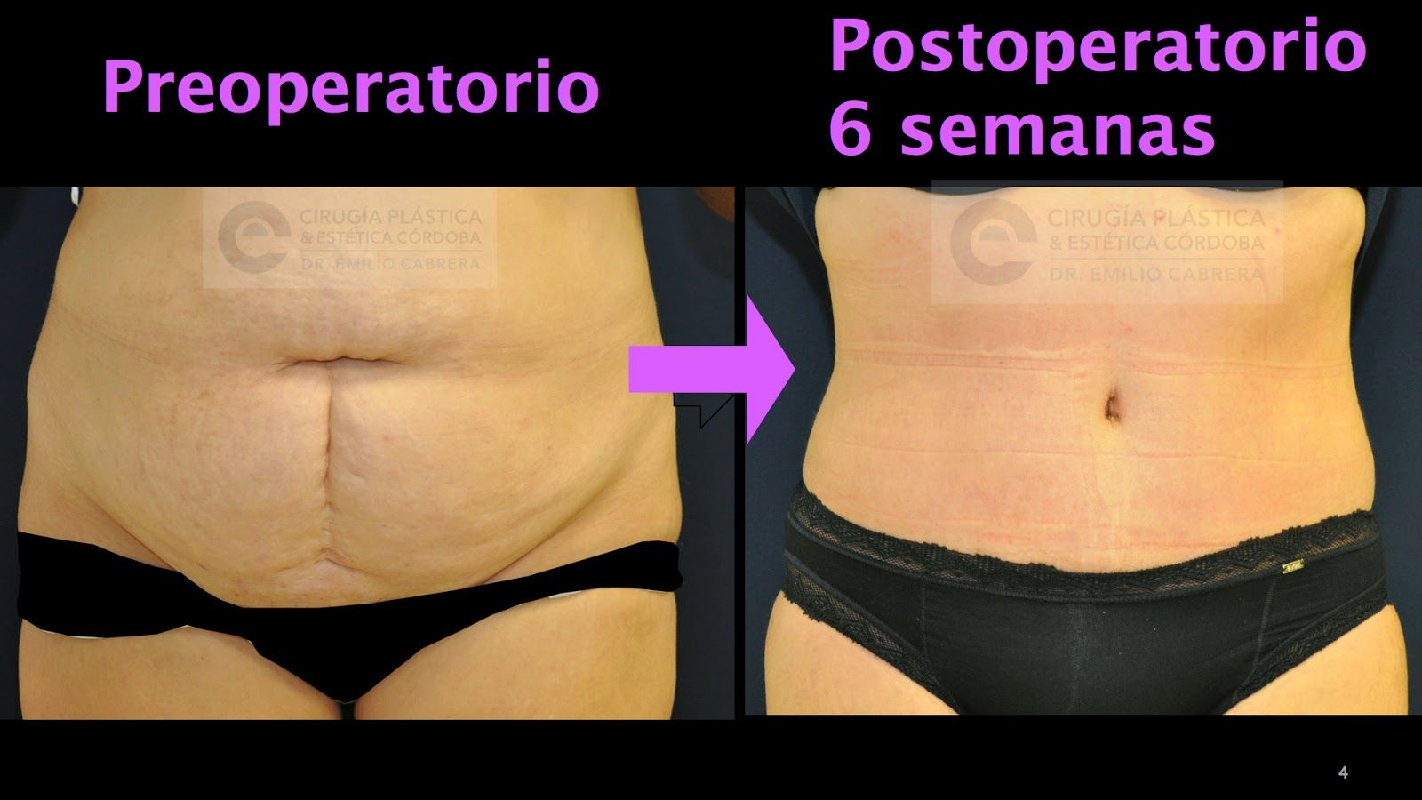 Recuperación de la abdominoplastia | Qué esperar semana a semana | Dr. Emilio Cabrera abdominoplastia21 Recuperación de la abdominoplastia | Qué esperar semana a semana | Dr. Emilio Cabrera