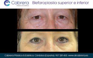 blefaroplastia1-300x188 Blefaroplastia: rejuveneciendo el "espejo del alma"