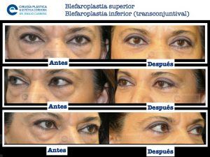 Recuperación de la blefaroplastia | Qué esperar semana a semana | Dr. Emilio Cabrera blefaroplastia4-300x225 Recuperación de la blefaroplastia | Qué esperar semana a semana | Dr. Emilio Cabrera