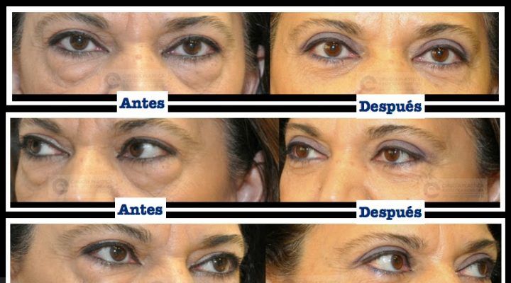 blefaroplastia4-720x400 Noticias blefaroplastia