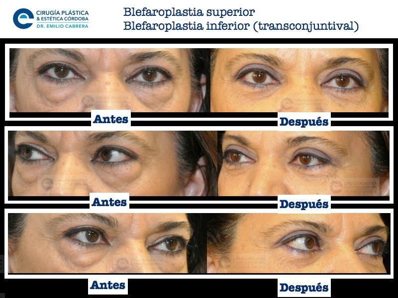 blefaroplastia4 Recuperación de la blefaroplastia | Qué esperar semana a semana | Dr. Emilio Cabrera