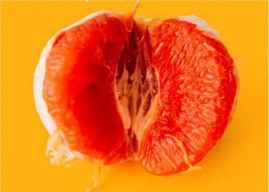 Cirugía femenina: rejuvenecer en la zona mas íntima es posible genital3-300x214 Cirugía femenina: rejuvenecer en la zona mas íntima es posible