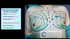 Recuperación de la operación de ginecomastia | Qué esperar | Dr. Emilio Cabrera ginecomastia31-300x169 Recuperación de la operación de ginecomastia | Qué esperar | Dr. Emilio Cabrera