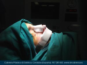 Tras una rinoplastia: consejos para un adecuado postoperatorio rinoplastia5-300x224 Tras una rinoplastia: consejos para un adecuado postoperatorio