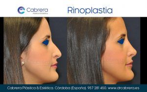 rinoplastia6-300x188 ¿Cuál es el objetivo final que busca el cirujano plástico con una rinoplastia?