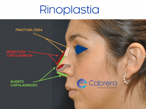 rinoplastia7-300x225 ¿Qué es una nariz atractiva y cómo conseguirla?