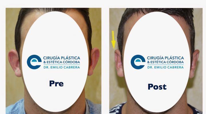 otoplastia-1-720x400 Noticias otoplastia