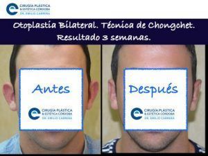 otoplastia-6-300x225 Solución para un objeto de burla: las orejas