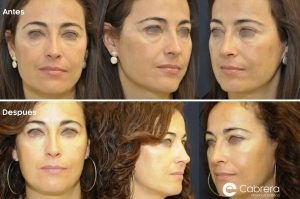 antes-despues-blefaroplastia-22-1-300x199 Precio de la blefaroplastia | Dr. Emilio Cabrera