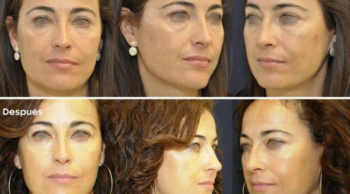 antes-despues-blefaroplastia-22-1-720x400 Noticias blefaroplastia