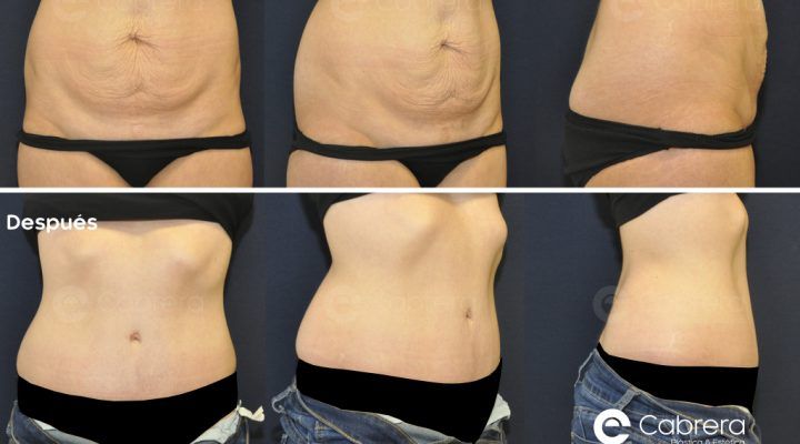 antes-despueìs-abdominoplastia-29-720x400 Noticias abdominoplastia