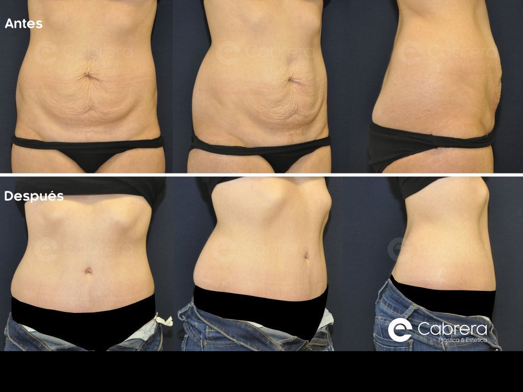 antes-despueìs-abdominoplastia-29 Abdominoplastia postparto | Recupera tu figura | Dr. Emilio Cabrera