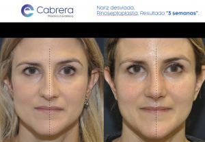 Captura-de-pantalla-2019-05-09-a-las-13.05.31-300x207 Rinoplastia: no solo una cuestión estética. ¡Puedo respirar!