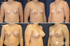 ¿Hay dos aumentos de pecho iguales? antes-después-aumento-de-pecho-84.001-300x199 ¿Hay dos aumentos de pecho iguales?