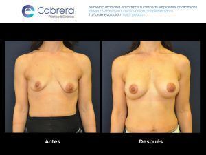 Motivos de insatisfacción tras una cirugía estética asimetria-insatisfaccion.001-300x225 Motivos de insatisfacción tras una cirugía estética