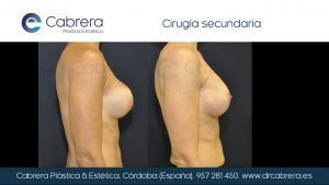 RECAMBIO-2.003-300x169 Tipos de prótesis mamarias | Cuál es la mejor para ti | Dr. Emilio Cabrera