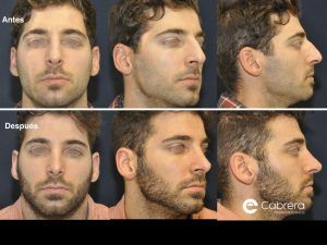 antes-despues-rinoplastia-23-ok-300x225 Contra la leyenda negra de la rinoplastia