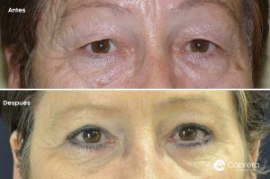 ANTES-DESPUES-BLEFAROPLASTIA-CASO-14-300x199 ¿Puede rejuvenecer el rostro una blefaroplastia?