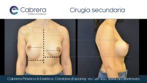 ¿Cuál es la proporción del pecho ideal? CON.P.O-PERFILES.002-300x169 ¿Cuál es la proporción del pecho ideal?