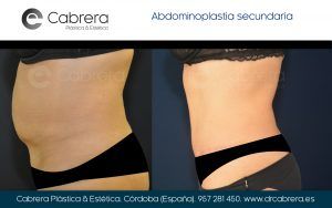 Doctor... ¿tiene solución? Cirugía secundaria de abdominoplastia ABDOMINOPLASTIA-MRL.005-300x188 Doctor... ¿tiene solución? Cirugía secundaria de abdominoplastia