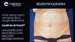 ¿Cómo me veré a las 5 semanas de una abdominoplastia? Sin-título-1-300x169 ¿Cómo me veré a las 5 semanas de una abdominoplastia?