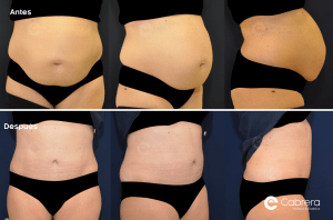 Precio de la abdominoplastia | Dr. Emilio Cabrera antes-despues-abdominoplastia-caso-43-300x198 Precio de la abdominoplastia | Dr. Emilio Cabrera