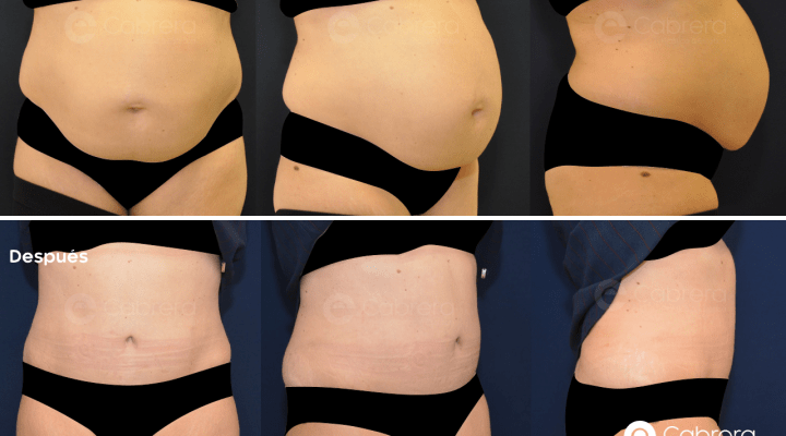 antes-despues-abdominoplastia-caso-43-720x400 Noticias abdominoplastia