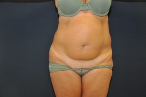 Resultados naturales y espectaculares en abdominoplastia. Sí, es el mismo abdomen. DSC_0237-300x199 Resultados naturales y espectaculares en abdominoplastia. Sí, es el mismo abdomen.