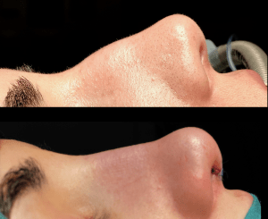 Cirugía preservadora nasal: la nueva rinoplastia. Captura-de-pantalla-2020-06-13-a-las-13.31.08-300x245 Cirugía preservadora nasal: la nueva rinoplastia.