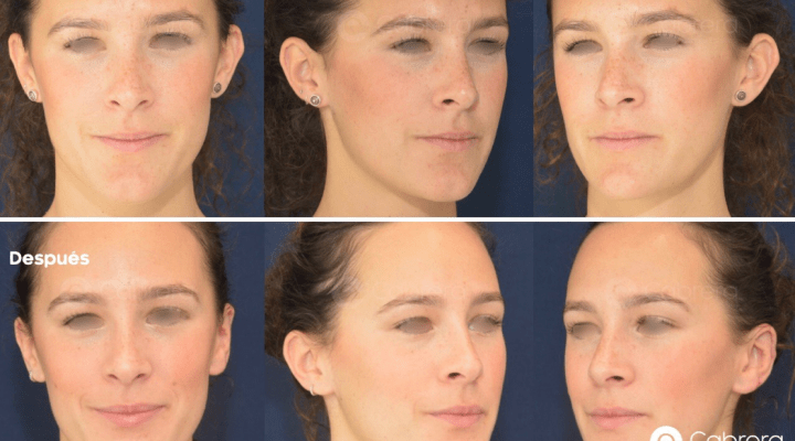 antes-despues-otoplastia-caso-36-720x400 Noticias otoplastia