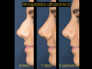 Captura-de-pantalla-2020-07-27-a-las-12.04.22-300x225 Recuperación de la rinoplastia | Qué esperar semana a semana | Dr. Emilio Cabrera