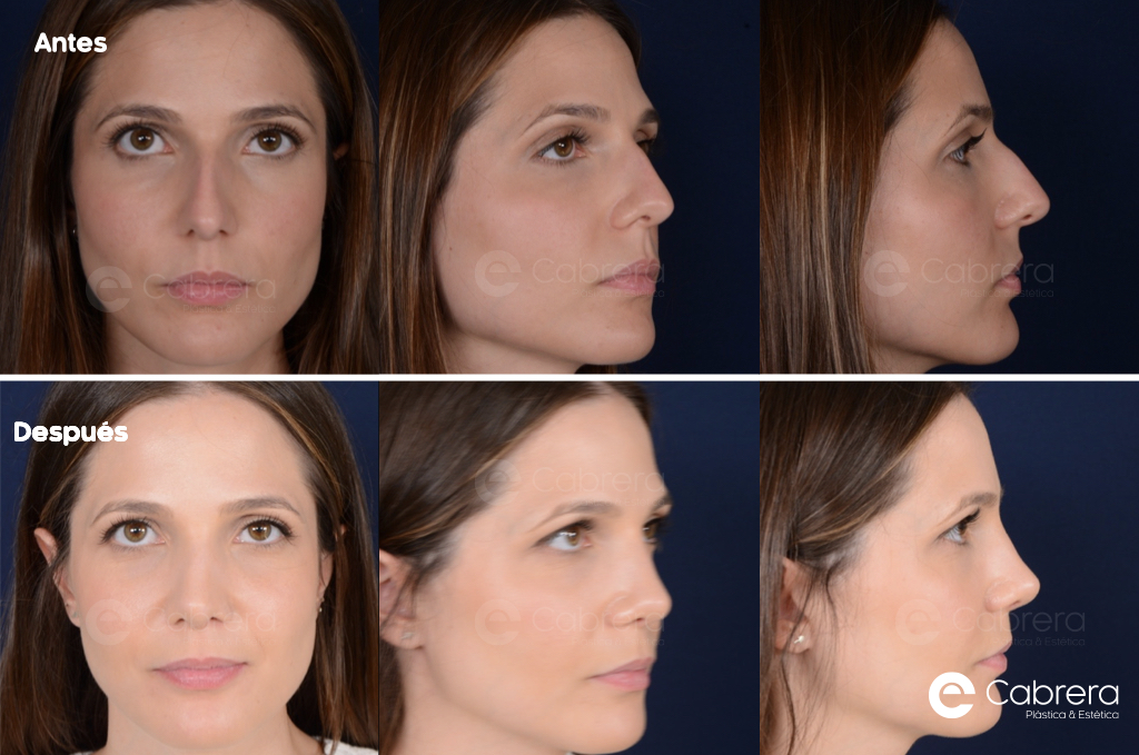 RINOPLASTIA-KEYNOTE-2.001 Antes y después en rinoplastia