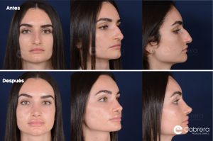RINOPLASTIA-KEYNOTE.001-300x199 Precio de la rinoplastia | Dr. Emilio Cabrera
