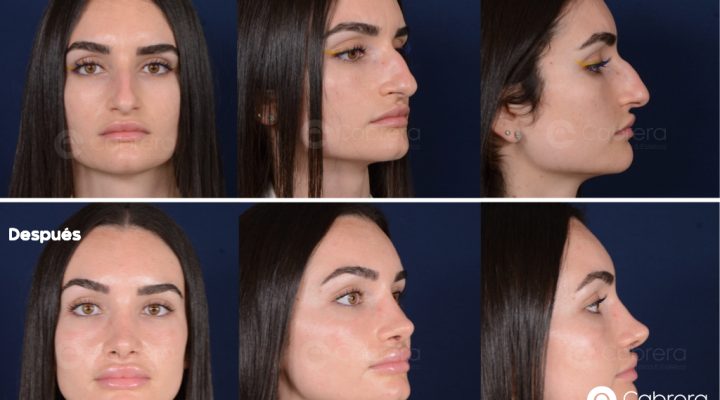 RINOPLASTIA-KEYNOTE.001-720x400 Noticias rinoplastia