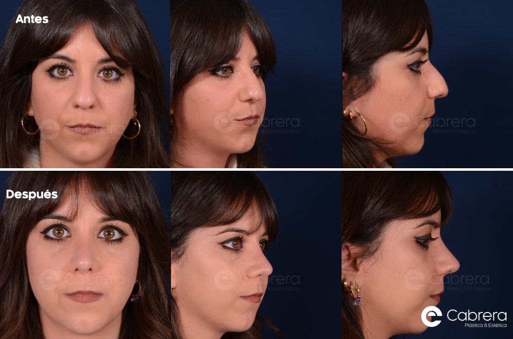 Captura-de-pantalla-2024-03-13-a-las-11.44.46 Antes y después en rinoplastia