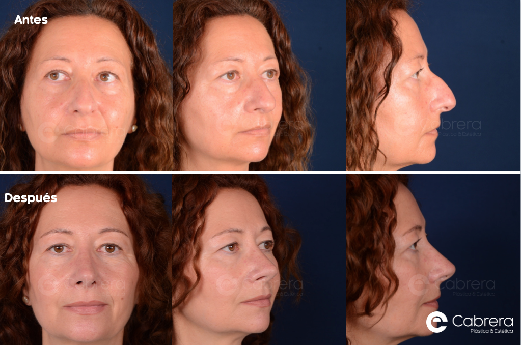 Captura-de-pantalla-2024-03-19-a-las-18.02.40 Antes y después en rinoplastia