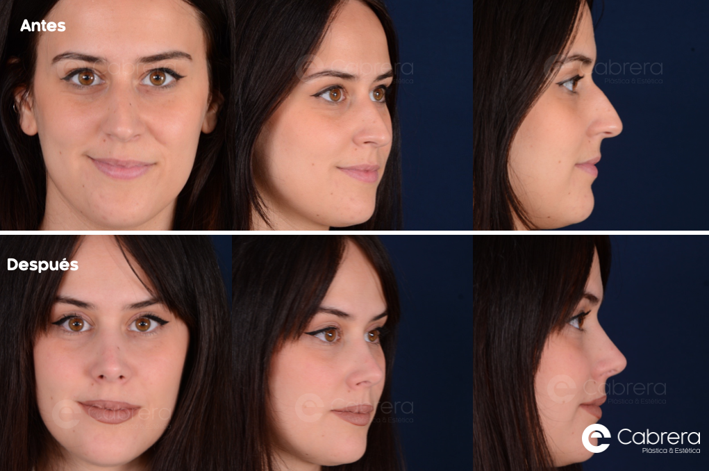 Captura-de-pantalla-2024-05-06-a-las-12.59.58 Antes y después en rinoplastia
