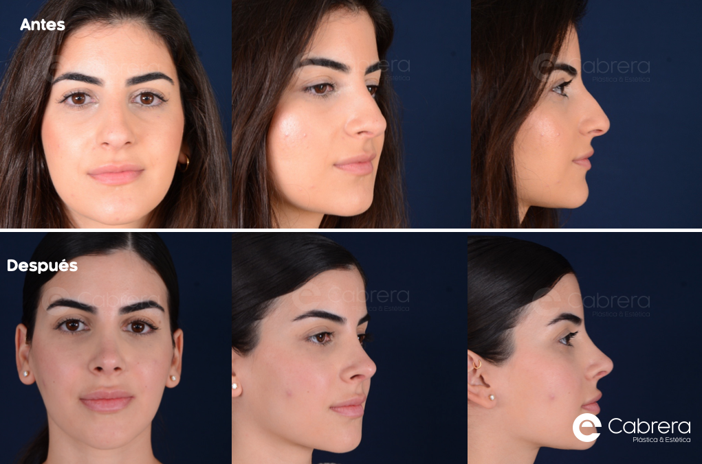 Captura-de-pantalla-2024-05-06-a-las-13.05.29 Antes y después en rinoplastia