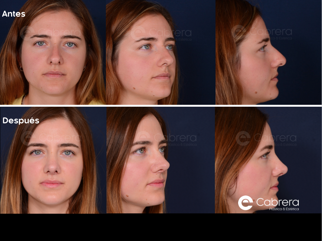 5782C Tipos de rinoplastia | Abierta, cerrada y de revisión | Dr. Emilio Cabrera