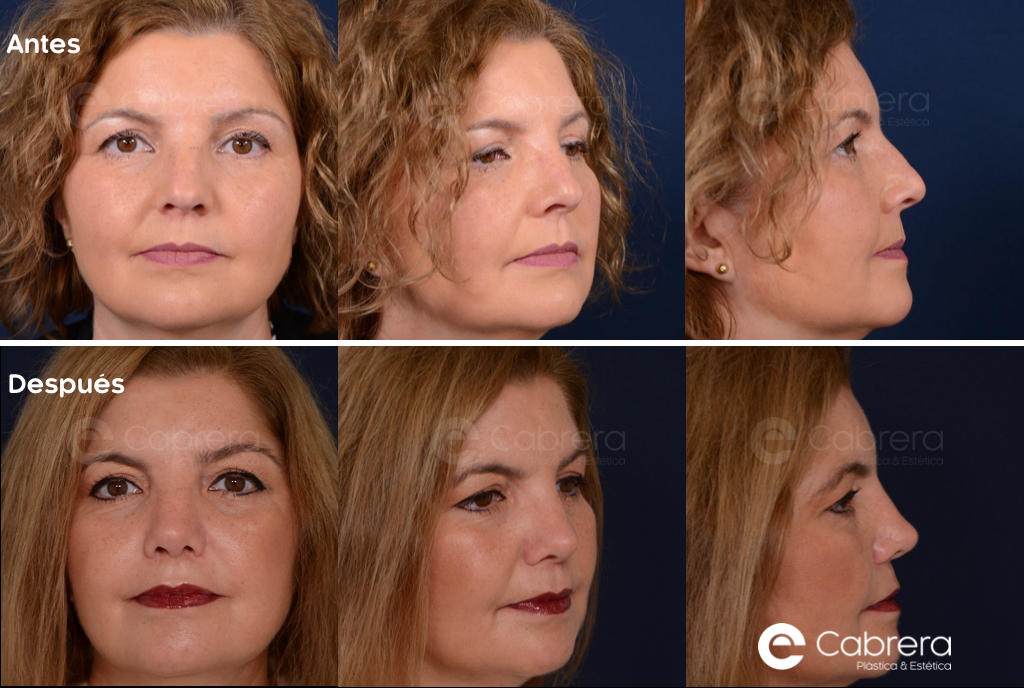 8215C Antes y después en rinoplastia