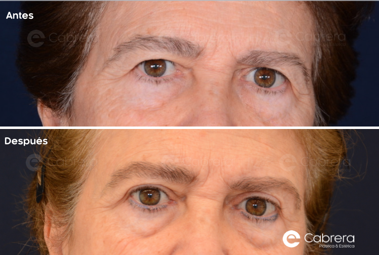 8479C Antes y después en blefaroplastia