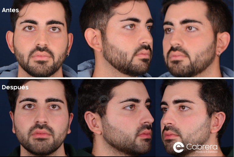 8727C Antes y después en otoplastia