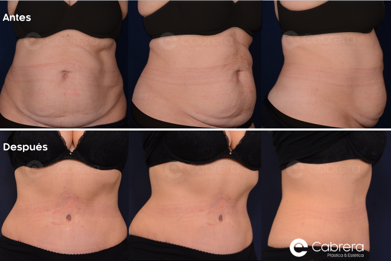 3269C Antes y después en abdominoplastia